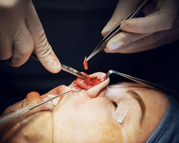rhinoplasty process photos for allure.com's life in plastic column