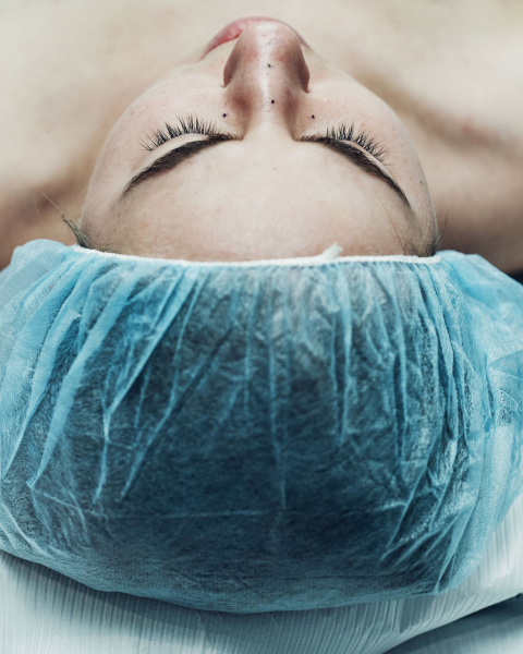 rhinoplasty process photos for allure.com's life in plastic column